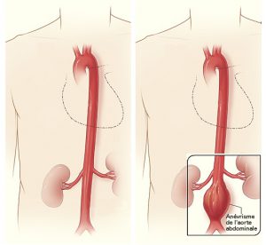 l’anévrisme de l’aorte abdominale